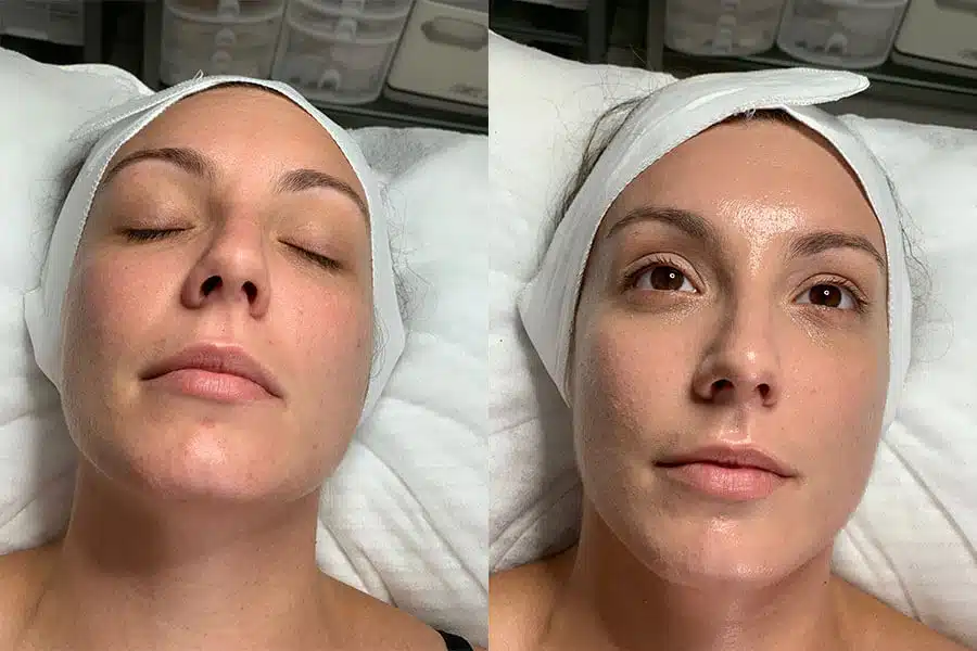 Hydra Delux Facial - skin hydration treatment Sydney